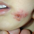 misuse_fucidin020221.jpg