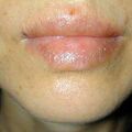 misuse_fucidin020508.jpg