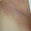 misuse_fucidin020806.jpg