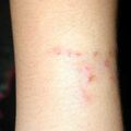 misuse_fucidin020824-1.jpg
