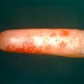 misuse_fucidin8-707.jpg