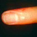 misuse_fucidin8-708.jpg