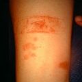 misuse_fucidin9-515.jpg