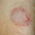 misuse_funginazol010803.jpg
