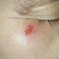 misuse_herpes010224.jpg