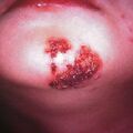 misuse_herpes_dermatop2000-67.jpg