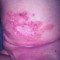 misuse_herpessimplex6-208.jpg