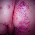 misuse_herpessimplex6-209.jpg
