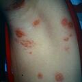 misuse_impetigo9-335.jpg