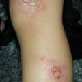 misuse_isozym020826.jpg