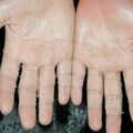 misuse_ketoconazole010623-1.jpg