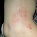 misuse_ketoconazolel010924.jpg