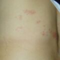 misuse_ketona020122.jpg