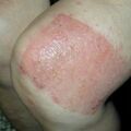 misuse_ketotop010523-2.jpg
