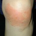 misuse_ketotop020209-2.jpg