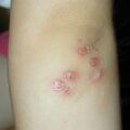 misuse_lacticarhc020723.jpg