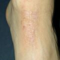 misuse_lamisil010529.jpg