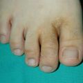 misuse_lamisil020727-2.jpg