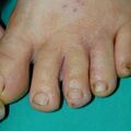 misuse_lamisil020819.jpg
