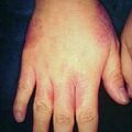 misuse_lamisil9-1082.jpg