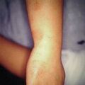 misuse_lamisil9-1083.jpg