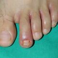 misuse_lamisil_canesten020905-1.jpg