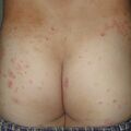 misuse_lindane020820-1.jpg