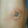 misuse_madecassol010531.jpg