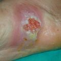 misuse_madecassol_fucidin020715.jpg