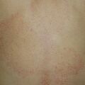 misuse_mentholatum010611.jpg