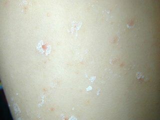 misuse_molluscum010220-2.jpg