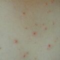 misuse_molluscum020806-1.jpg