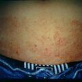 misuse_myderm9-347.jpg