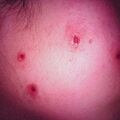 misuse_nevus2000-29.jpg