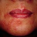 misuse_peeling9-560.jpg