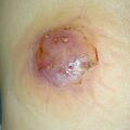 misuse_plaster020123-2.jpg