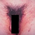 misuse_scabies2000-244.jpg
