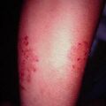misuse_scabies2000-245.jpg