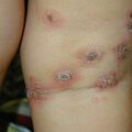 misuse_steroid010514.jpg