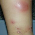 misuse_steroid0108161.jpg
