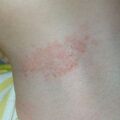misuse_steroid020323.jpg