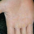 misuse_steroid020626-1.jpg