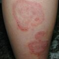 misuse_steroid020814.jpg
