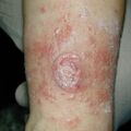 misuse_sulfanilamide020709.jpg