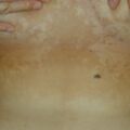 misuse_tarimazole020817-1.jpg