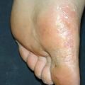 misuse_terbinafine010821.jpg