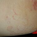 misuse_tinea010412-2.jpg