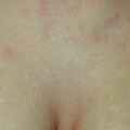 misuse_tricort010822.jpg