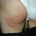 misuse_tricort020610.jpg