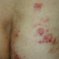 misuse_tricort_bactroban020902.jpg